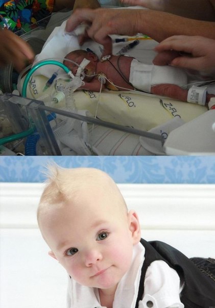 При рождении малышу давали всего 20% шансов на выживание. Второе фото сделано через год.